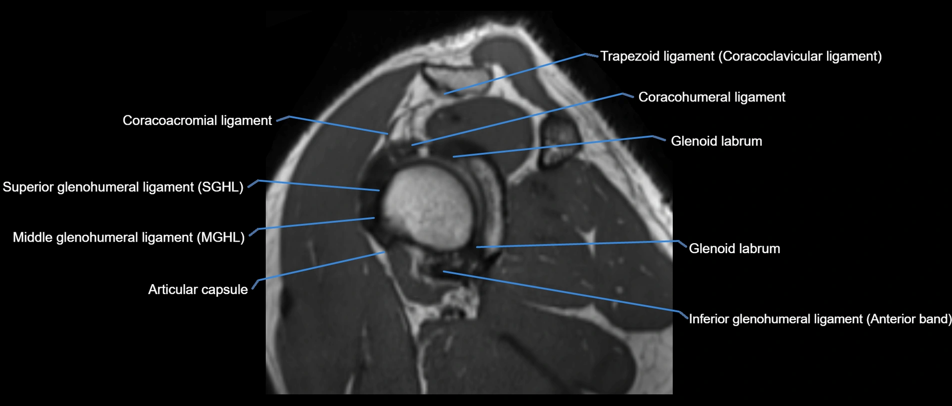 shoulder ligaments sagittal  cross sectional anatomy 3T MRI AI enhanced radiology image -img-00001-00029.webp
